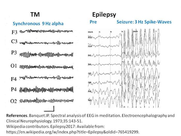 <b>However, whenever you mentioned synchrony to the medical community in the early 1970s , they inevitably thought of epilepsy.  TM is completely different from epilepsy in EEG frequency, morphology, and source of origin.</b>